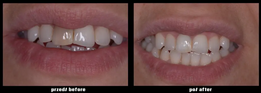 Wybielanie zęba martwego/ Whitening of a dead tooth