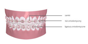 Ruchomy, stały, lingwalny aparat ortodontyczny oraz nakładki Invisalgin