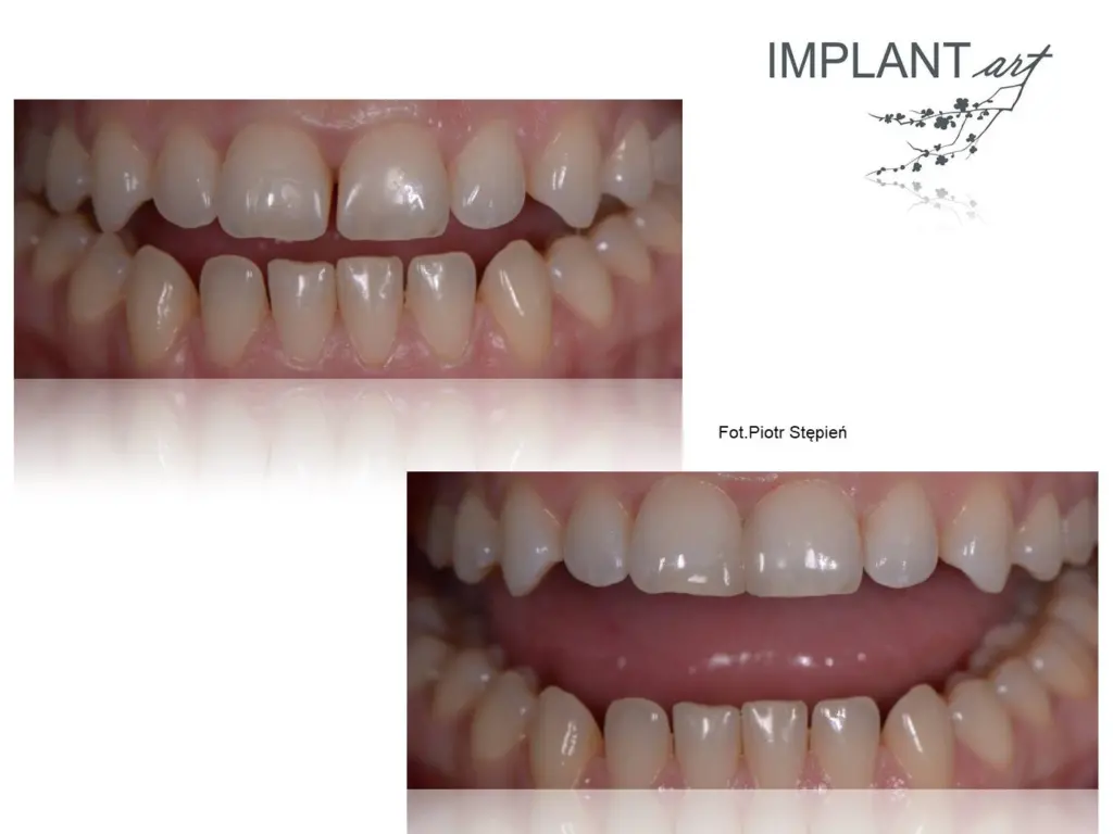 Estetyczne zamknięcie diastemy kompozytem/ Aesthetic closure of the diastema with composite