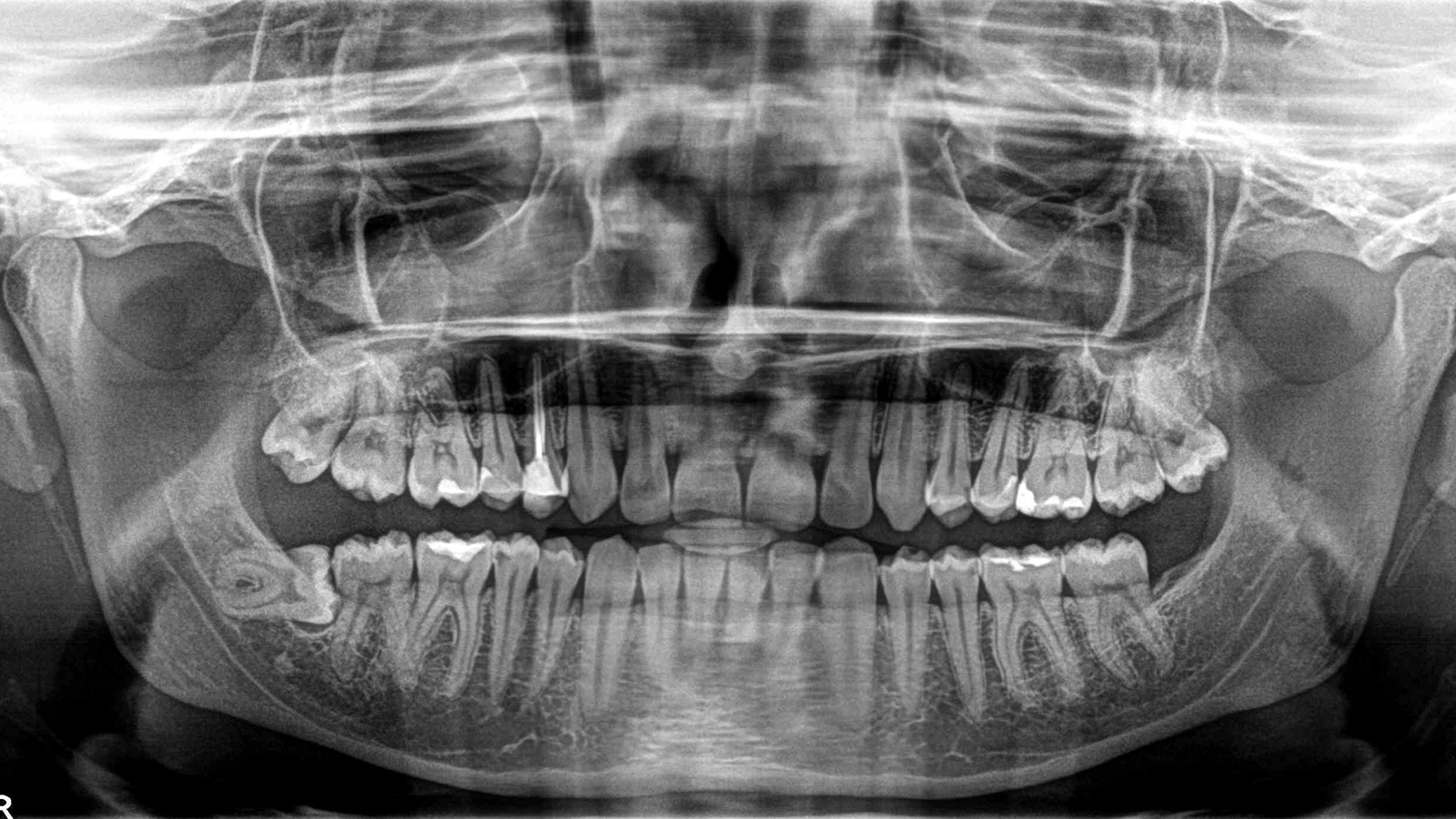 Wskazania dla pacjenta po ekstrakcji ósemki (zęba mądrości)