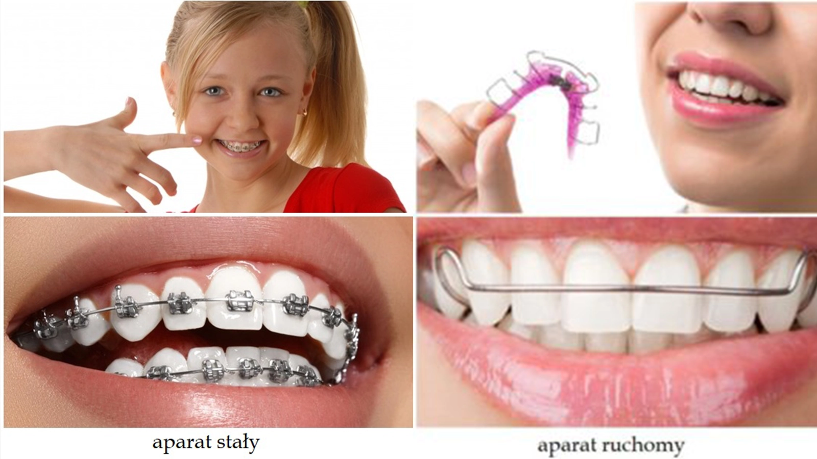 Ruchomy, stały, lingwalny aparat ortodontyczny oraz nakładki Invisalgin