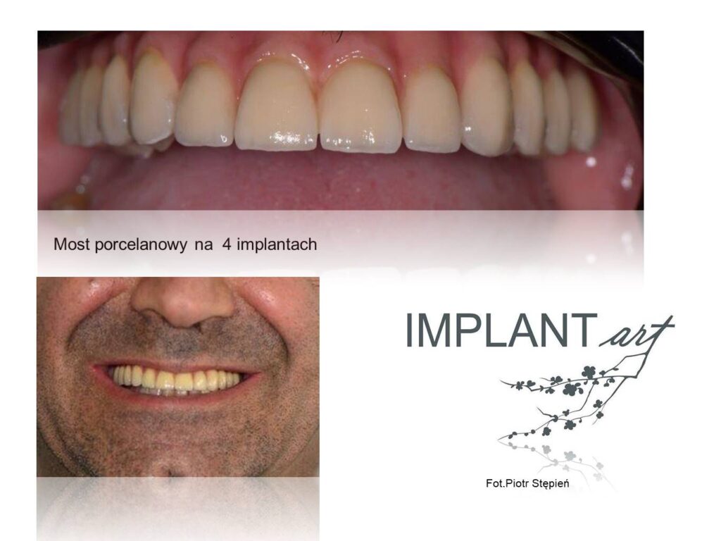 Z:\Implant-art\Materialy\Aktualnosci\Metoda All on 4 + most porcelanowy, przykecany