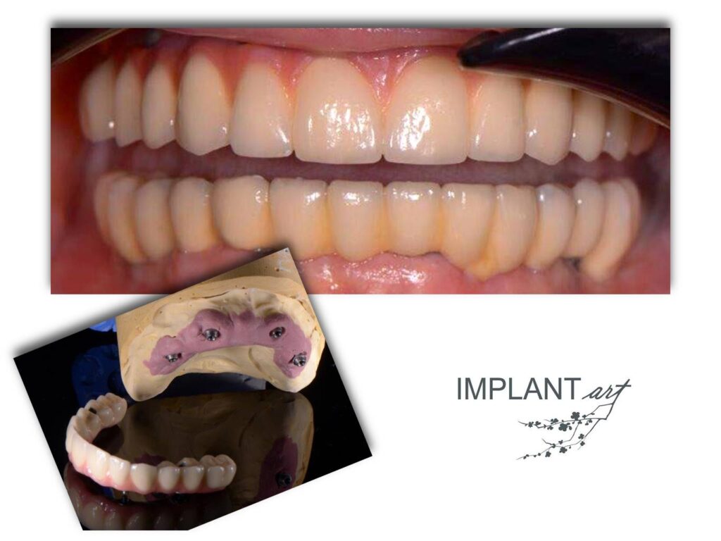 Program Simplant