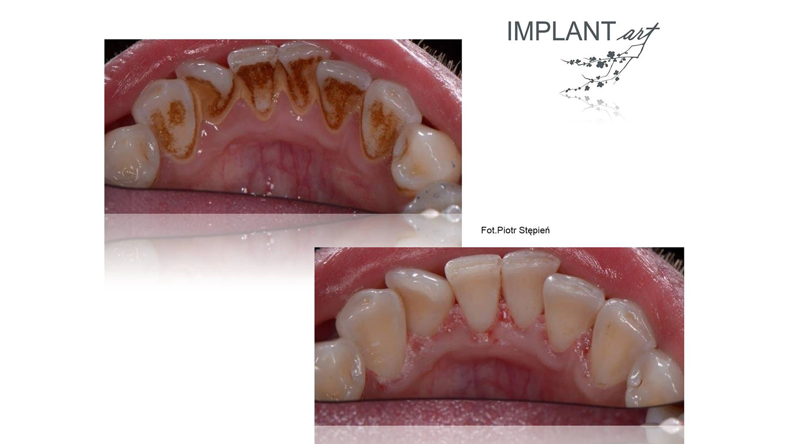 Hygienization (scaling + sandblasting)