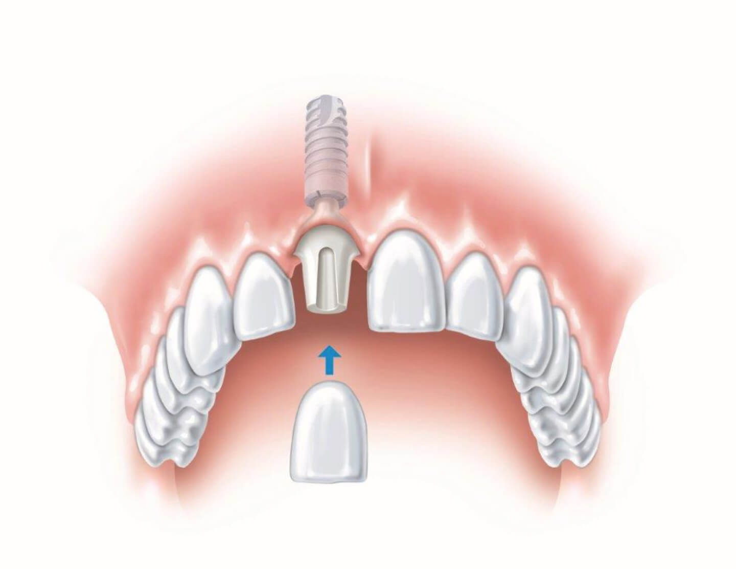 dobry implantolog, Wszczepianie implantu zębowego - przebieg leczenia