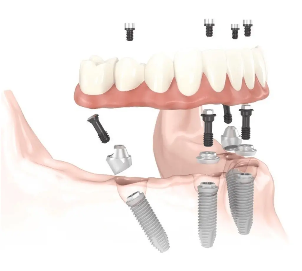 Implantologia, dobry implantolog dr Piotr Stępień, Implantology, good implantologist Dr. Piotr Stępień