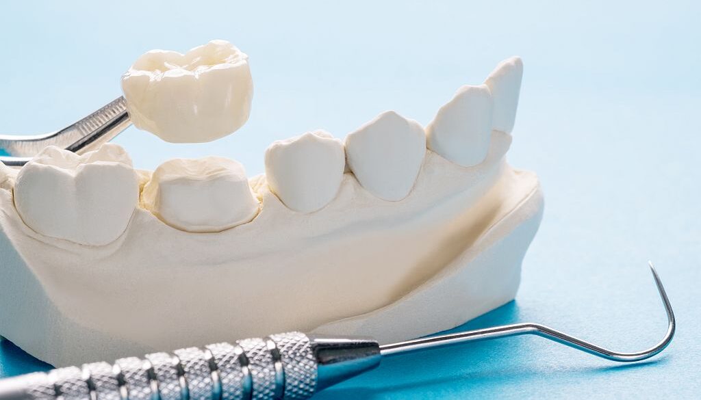 Czym różni się korona porcelanowa od ceramicznej?