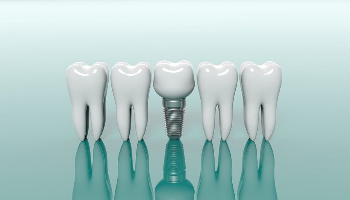 Ile można mieć implantów zębowych?