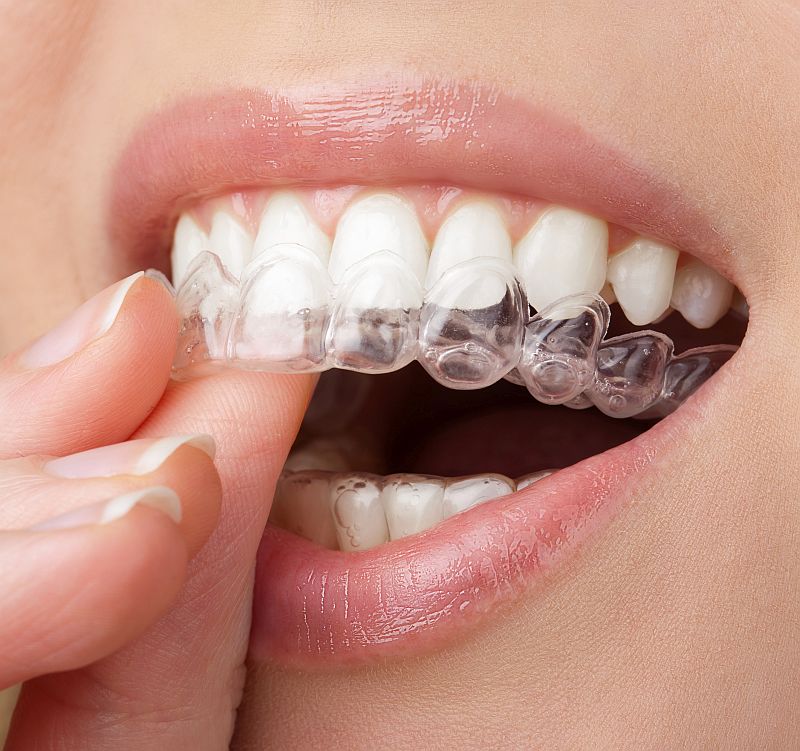 young woman holding whitening tray with gel. home teeth whitenin